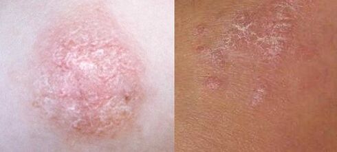 Psoriasi nella fase iniziale